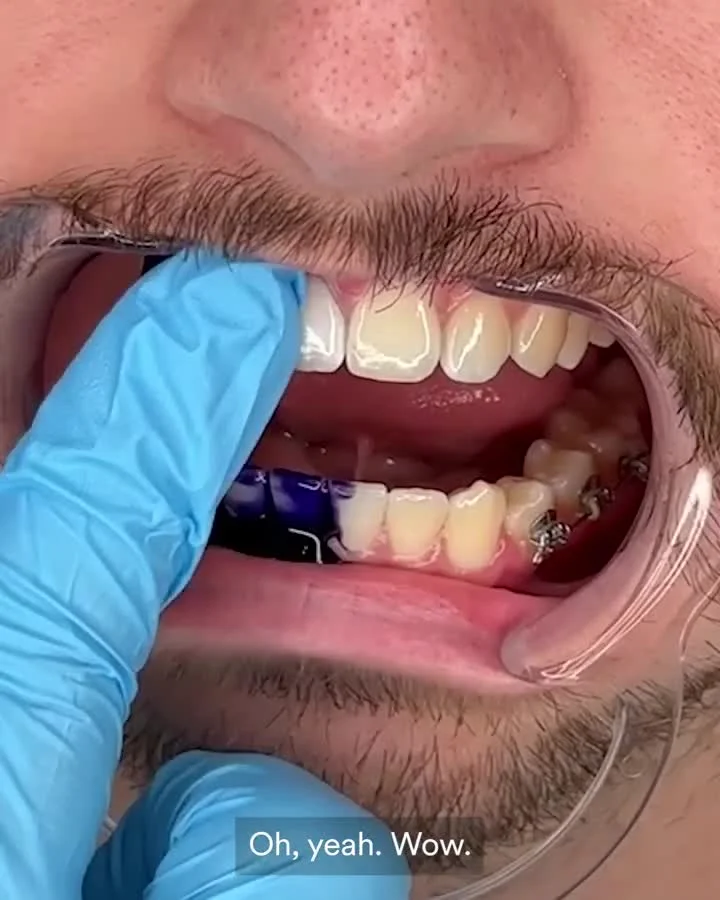 Anúncio em vídeo da hismile no formato Antes e Depois e Skit