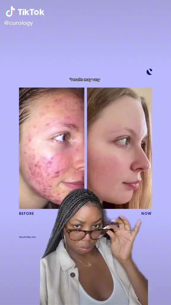 Anúncio em vídeo da Curology no formato Antes e Depois e Talking Head